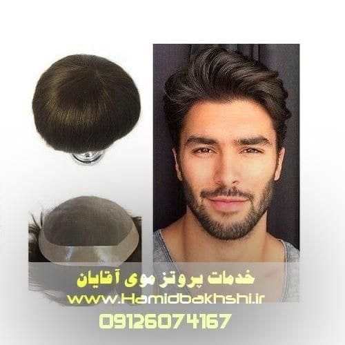 پروتز موی وارداتی در تهران