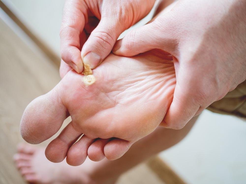 درمان میخچه پا با پدیکور