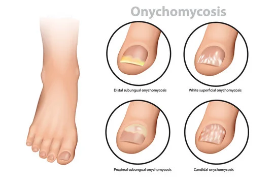 قارچ ناخن پا یا Onychomycosis