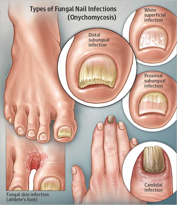 قارچ ناخن پا یا Onychomycosis