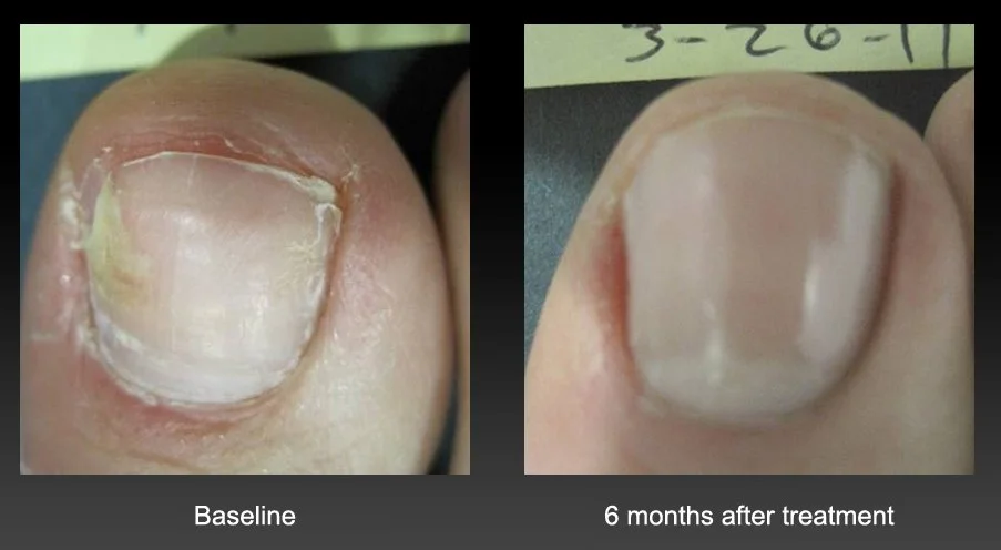 قارچ ناخن پا یا Onychomycosis
