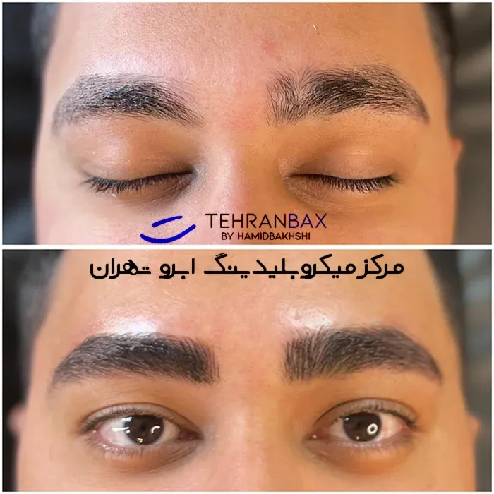 عکس قبل و بعد میکروبلیدینگ ابرو مردانه