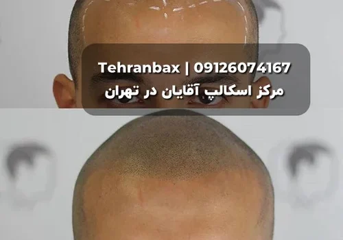 هزینه اسکالپ سر مردانه