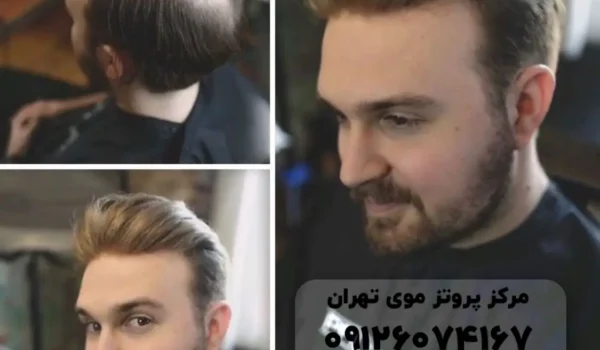 پروتز مو مردانه