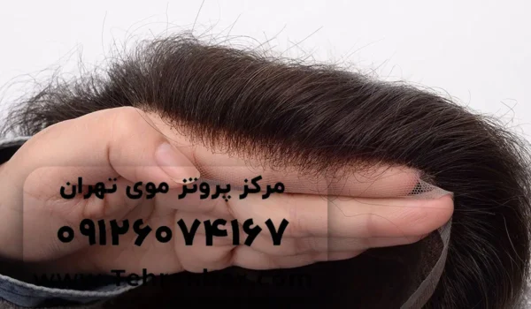پروتز مو