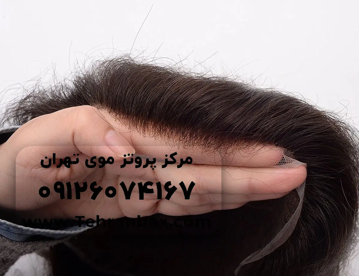 پروتز مو