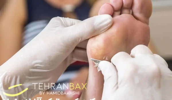 لایه برداری پای آقایان