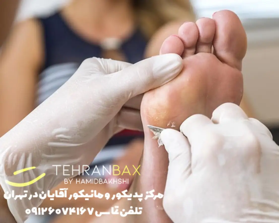 لایه برداری پای آقایان