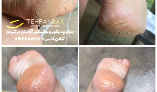 کلوس تراپی