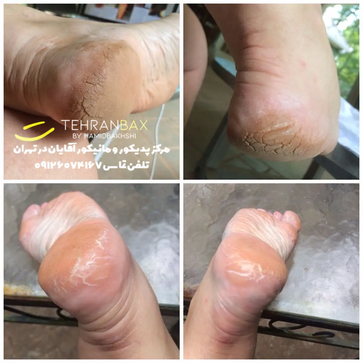 کلوس تراپی