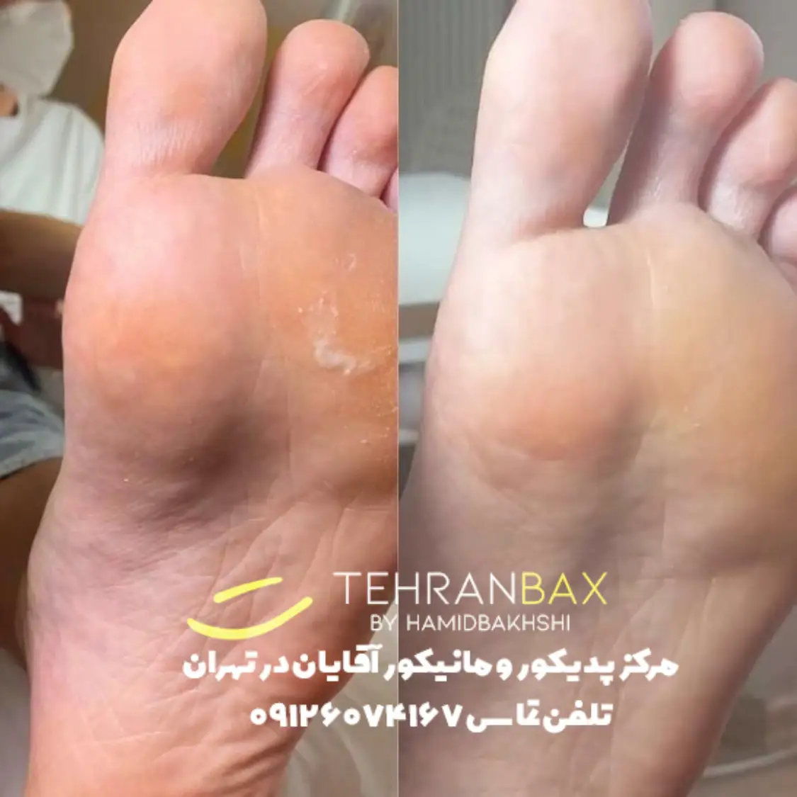 تراشیدن پوست مرده کف پای آقایان