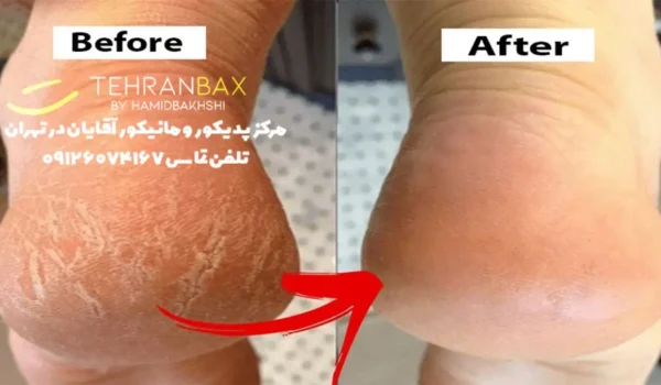 هزینه درمان ترک پا