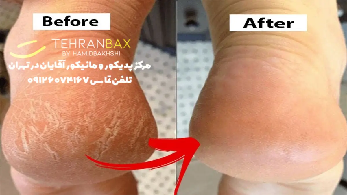 هزینه درمان ترک پا