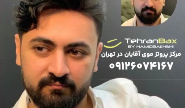 پروتز مو مردانه درجه یک