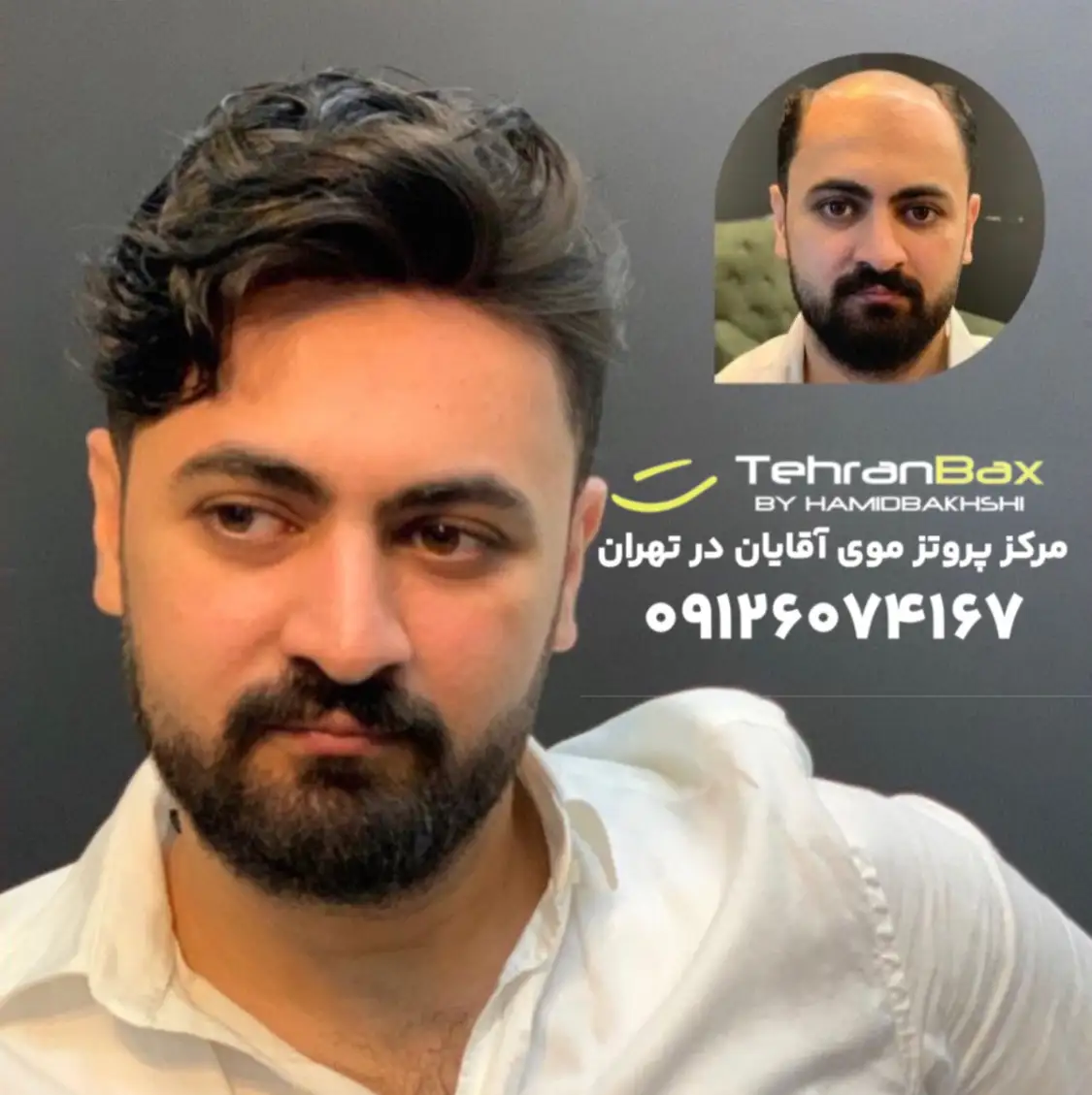 پروتز مو مردانه درجه یک