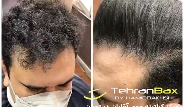 ریباندینگ موی آقایان