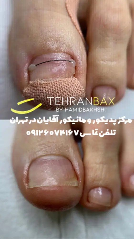فرو رفتن ناخن داخل گوشت در مردان