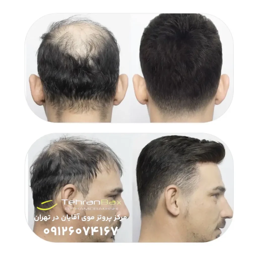 پروتز موی مردانه در آرایشگاه مردانه در تجریش