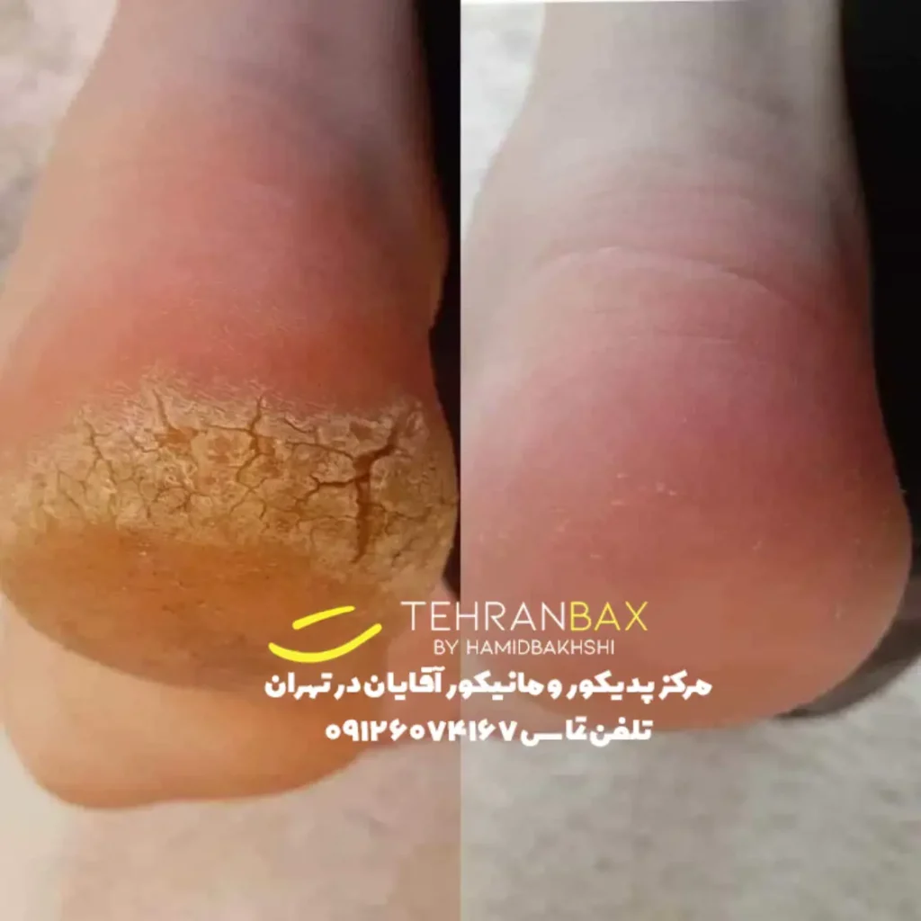 درمان پوسته پوسته شدن پای آقایان