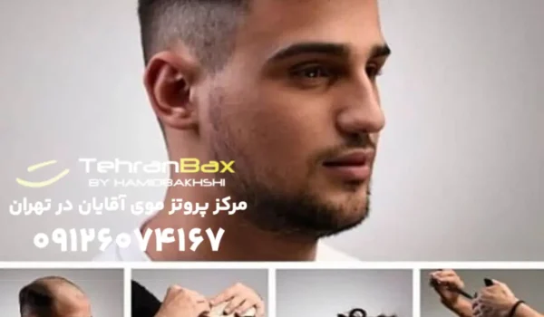 خرید پروتز مو