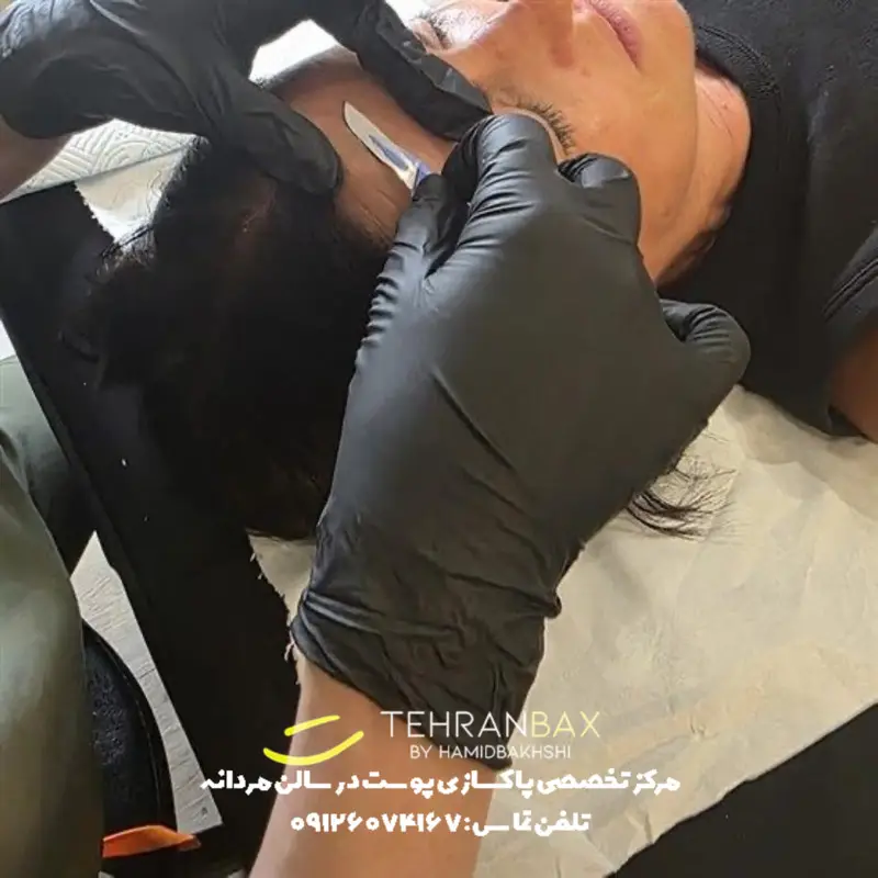 درماپلنینگ صورت مردانه در تهران